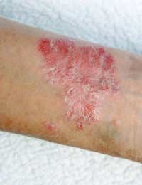 arm with dermatitis rash